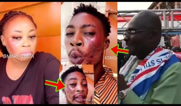 See What Hon Ken Is Saying As This Boy And Sis Compla!ns How Tiktok Cream Has Destr0yed Their Face