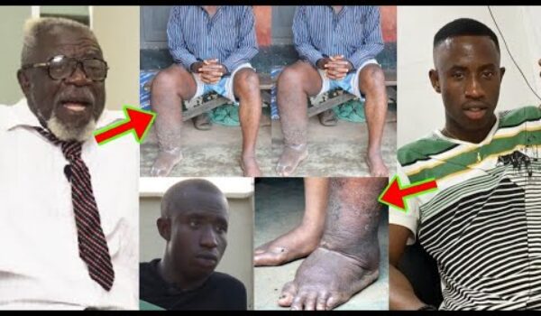 See How C Confion’s Lég And Chést Turned Big Before He D!ed