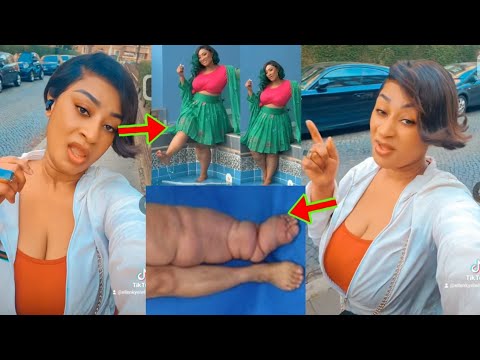 Read more about the article Actress Ellen Kyei White Shows Her Leg As She Reacted After Ghanaians Asked What Has Happened To Her